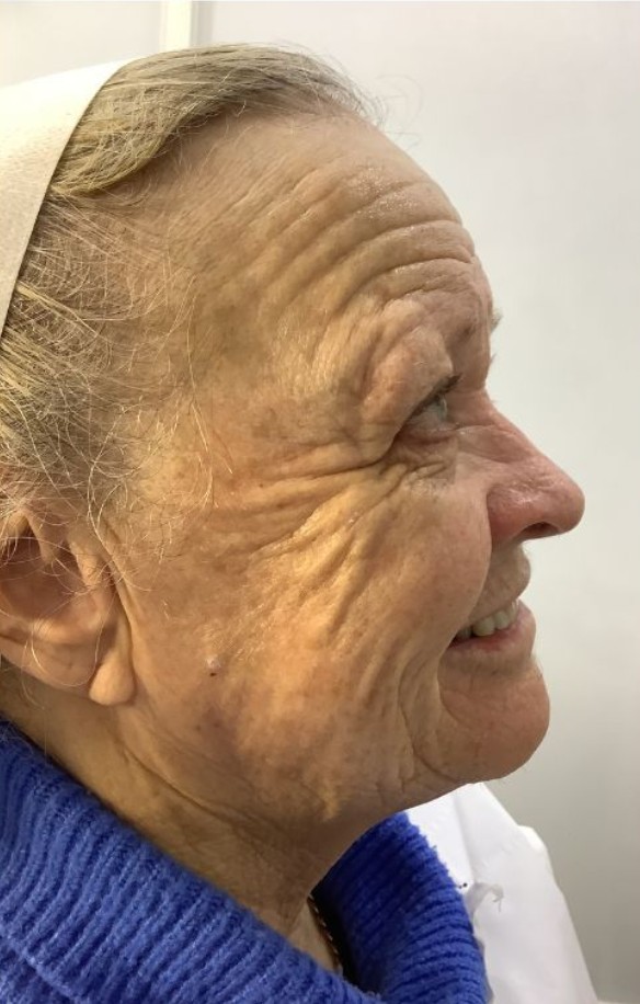 HIFU non-surgical facelift treatment area at Derma Cosmedic Liverpool