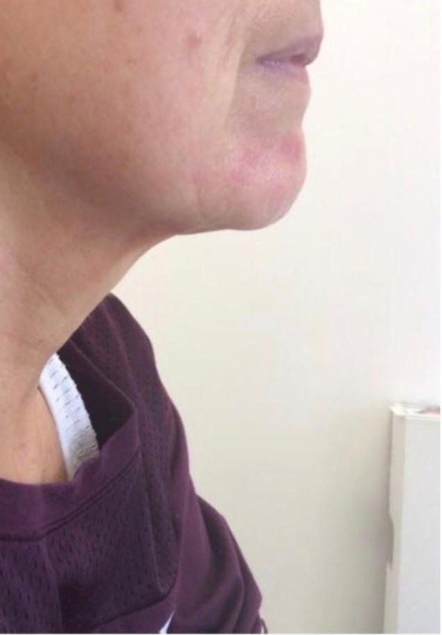 HIFU treatment result showing improved jawline at Derma Cosmedic Liverpool