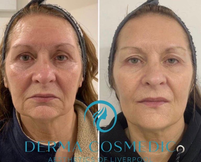 HIFU non-surgical facelift treatment at Derma Cosmedic Liverpool