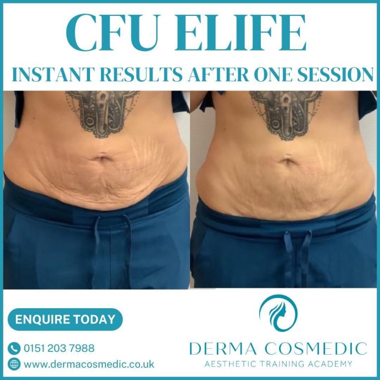 HIFU body fat reduction result at Derma Cosmedic Liverpool