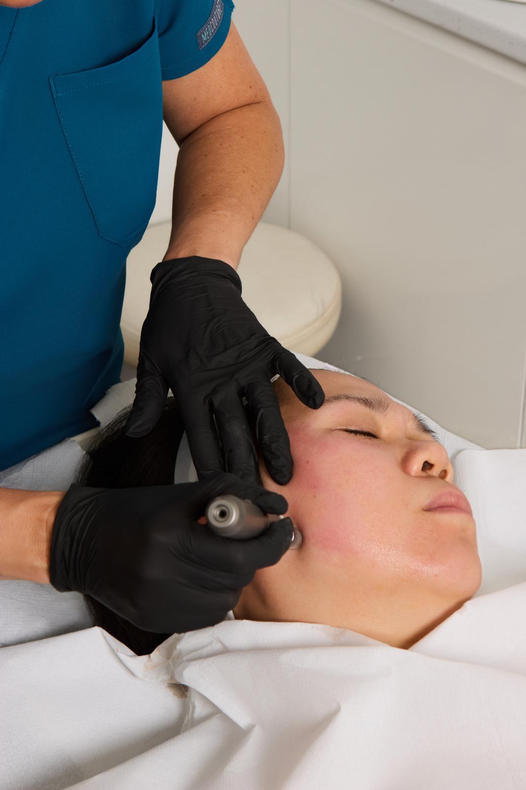 Microneedling training on a model at Derma Cosmedic academy Liverpool