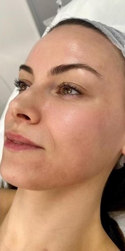 Skin after HydraFacial treatment at Derma Cosmedic Liverpool