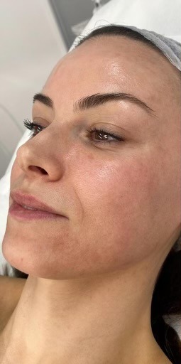 Skin before HydraFacial treatment at Derma Cosmedic Liverpool