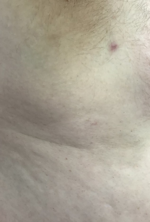 Skin lesion site after removal treatment at Derma Cosmedic Liverpool
